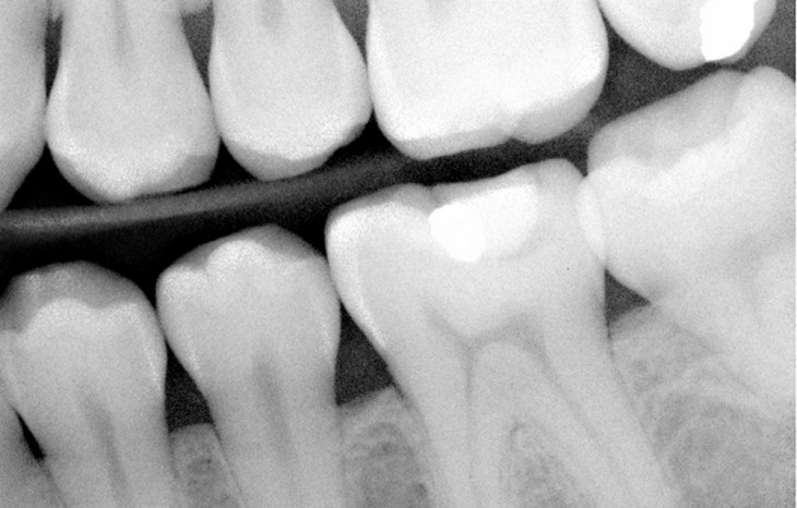 Diagnóstico é feito por uma radiografia odontológica. Foto: flickr.com/photos/jcolman.